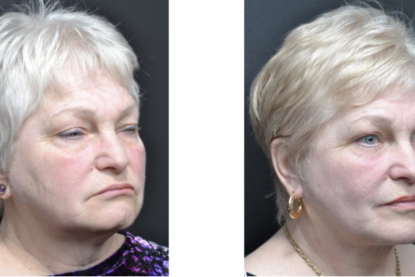 Cosmetic before-and-after photograph 15