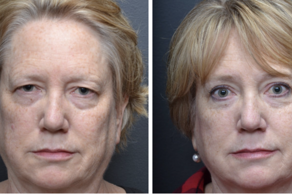 Cosmetic before-and-after photograph 16