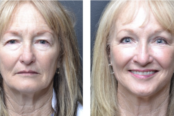 Cosmetic before-and-after photograph 17