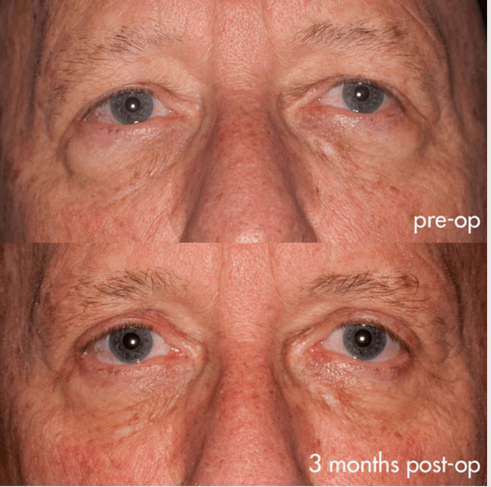 Eyelids before-and-after photograph 34