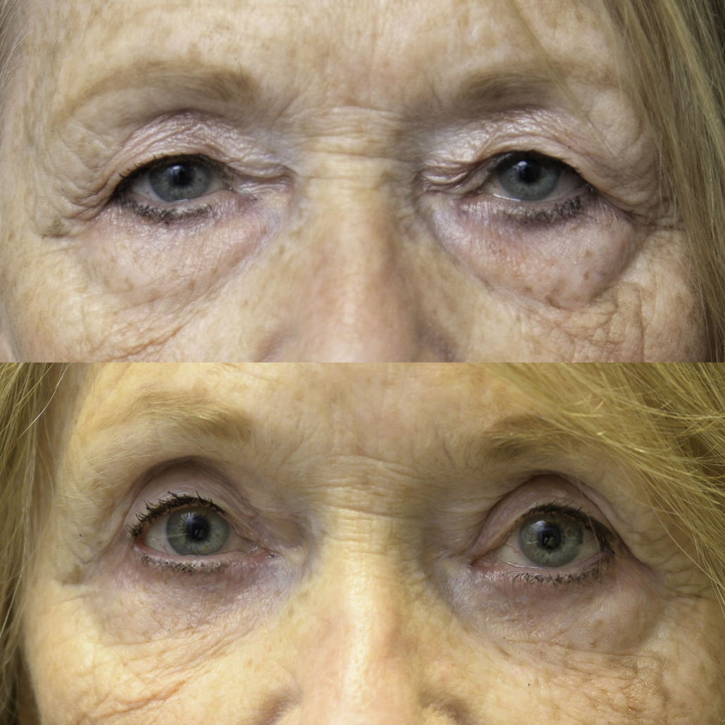 Eyelids before-and-after photograph 35