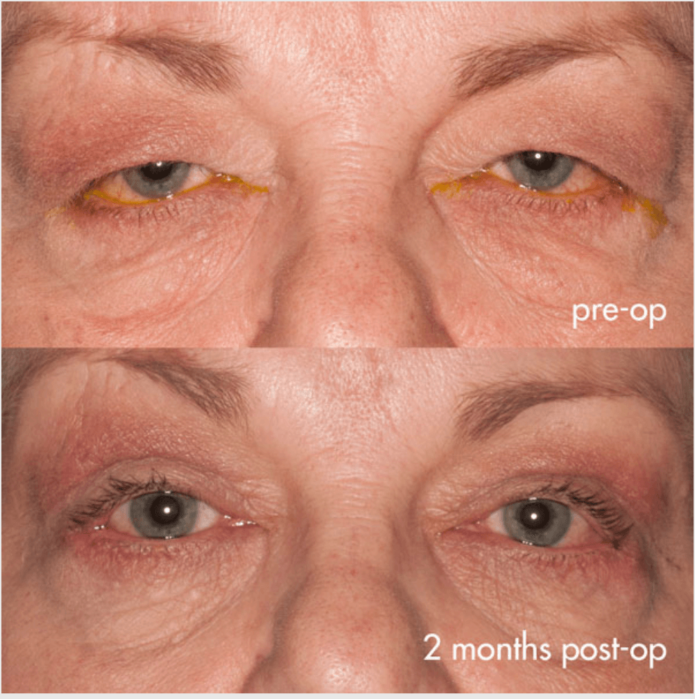 Eyelids before-and-after photograph 36