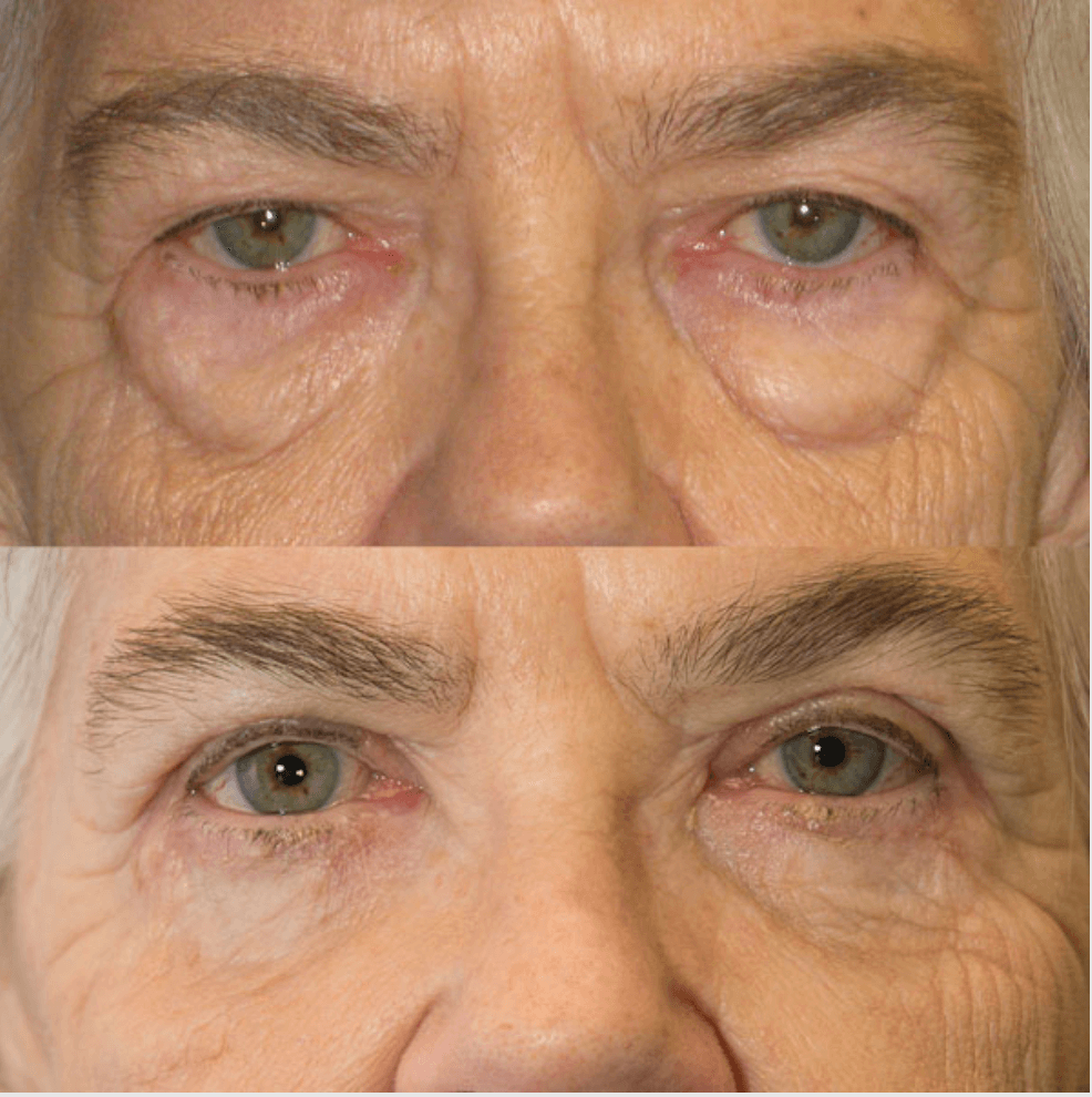 Eyelids before-and-after photograph 37