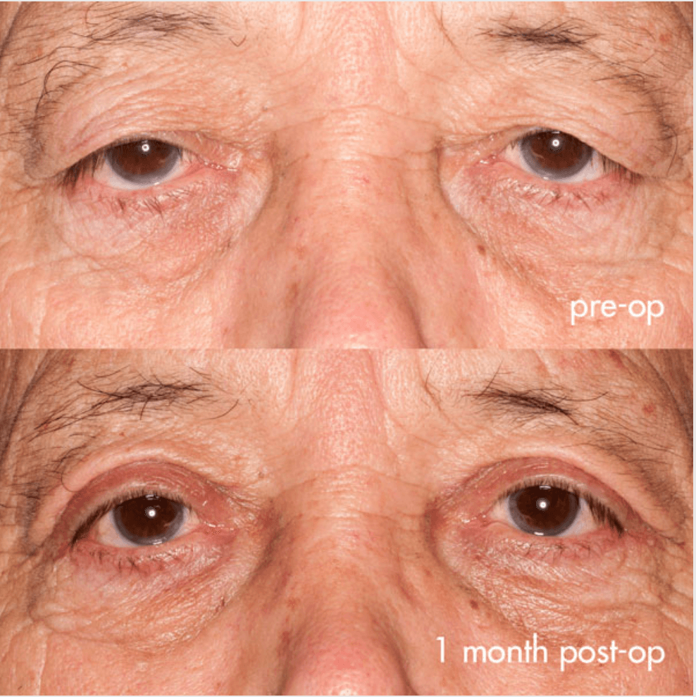 Eyelids before-and-after photograph 38