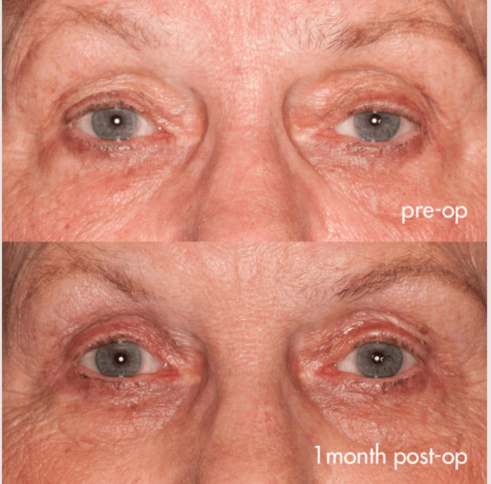 Eyelids before-and-after photograph 39