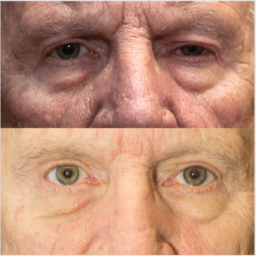 Eyelids before-and-after photograph 40