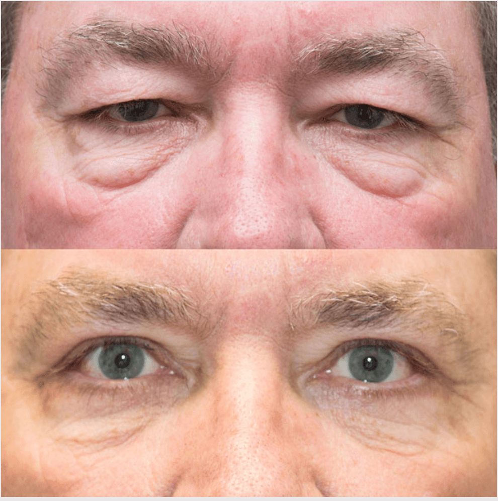 Eyelids before-and-after photograph 41