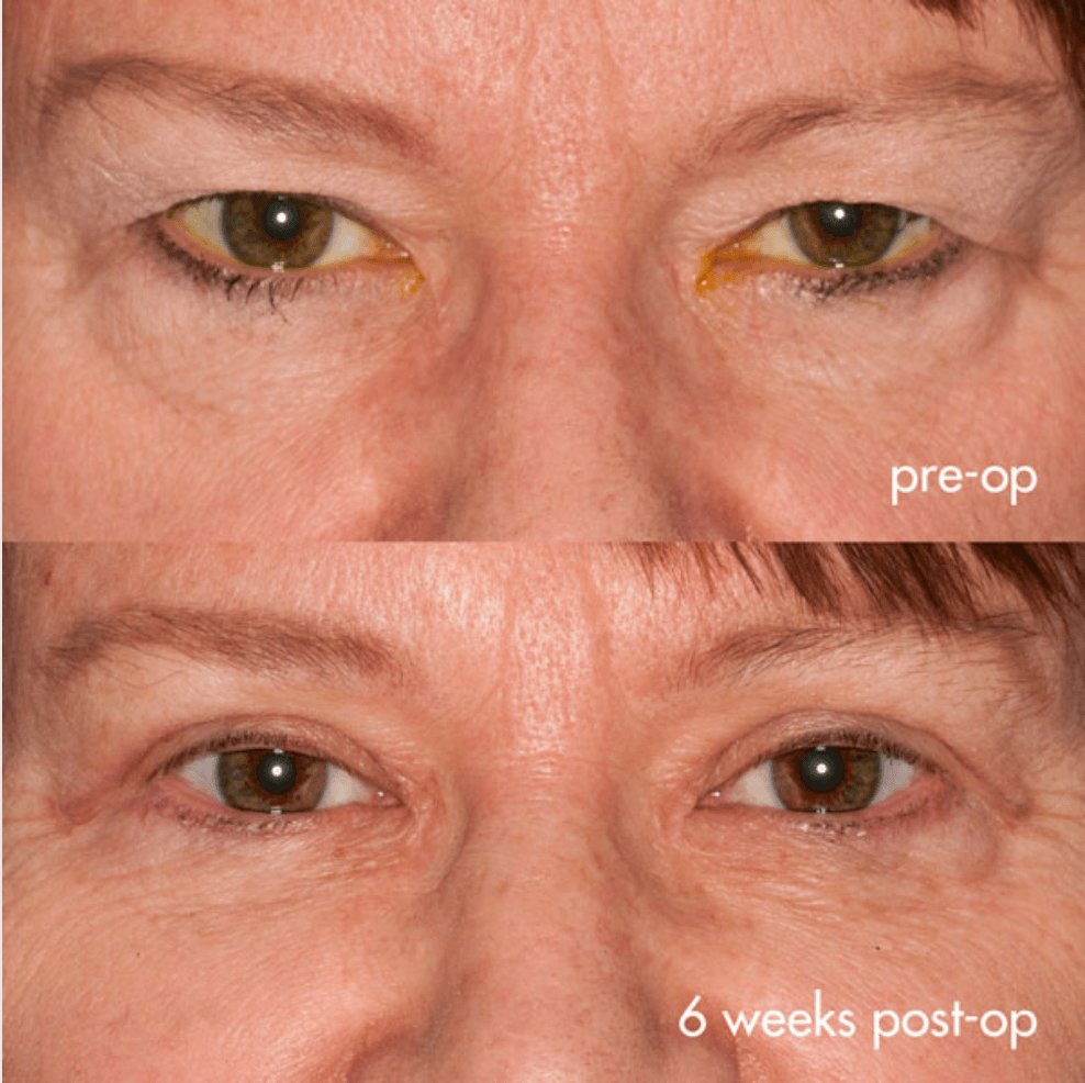 Eyelids before-and-after photograph 42