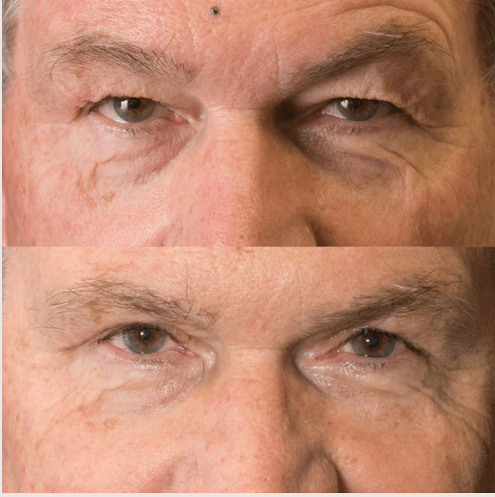 Eyelids before-and-after photograph 43
