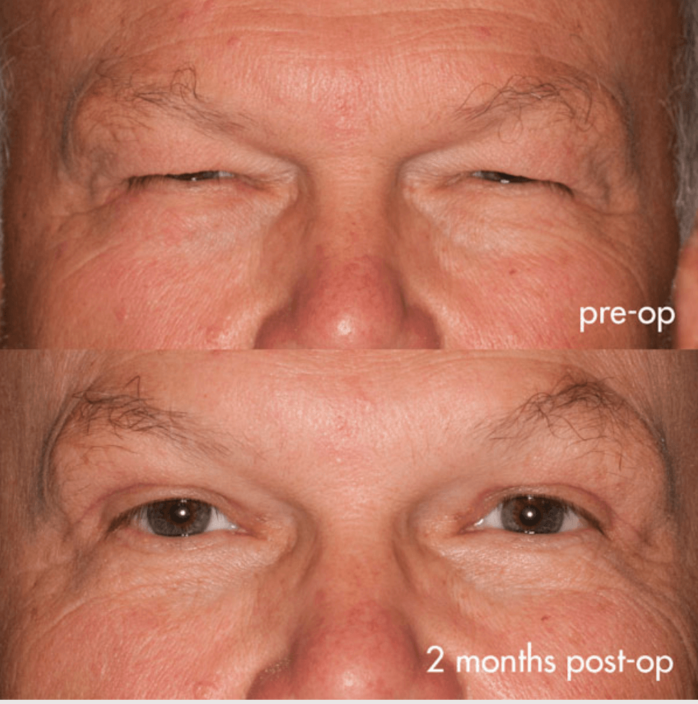 Eyelids before-and-after photograph 44