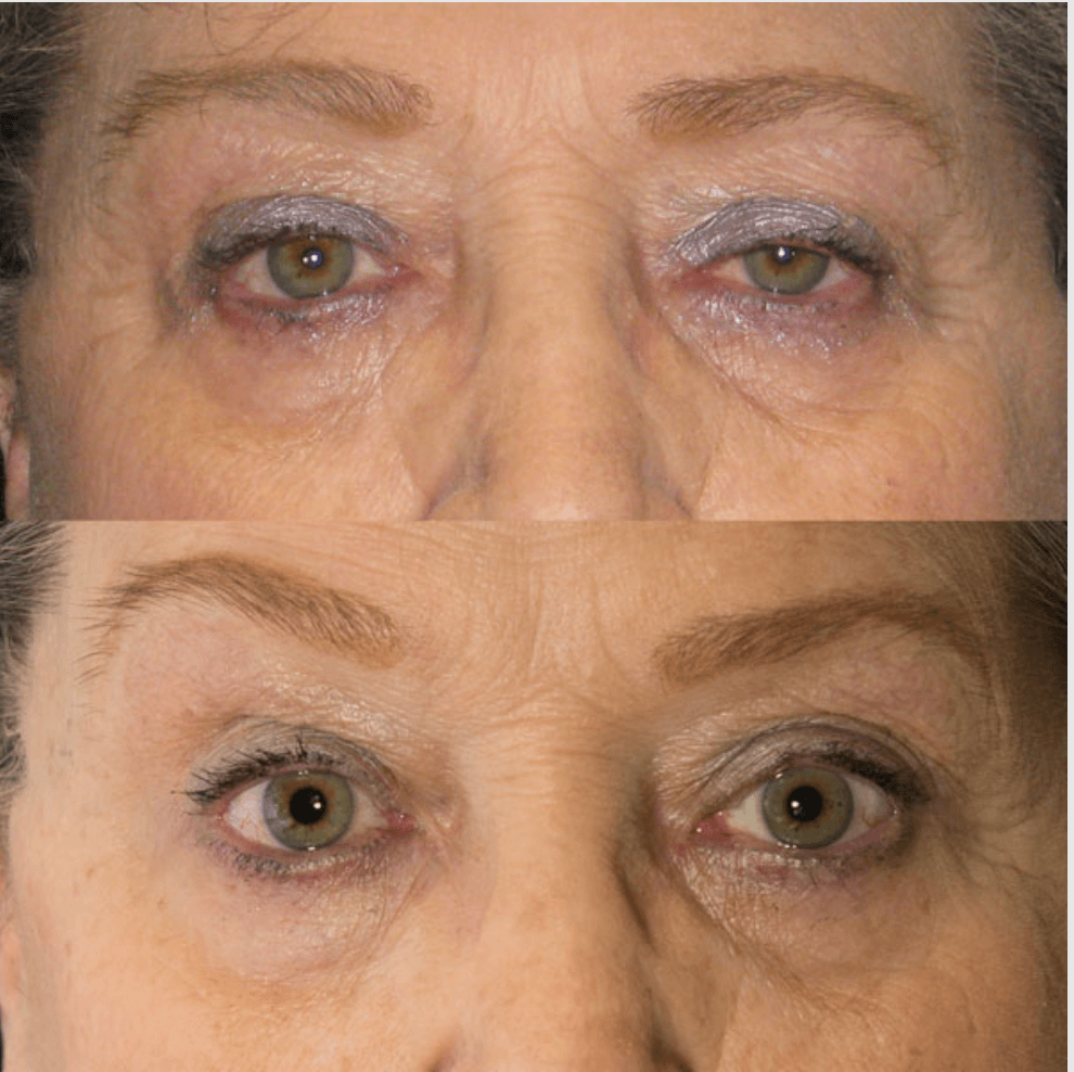 Eyelids before-and-after photograph 45