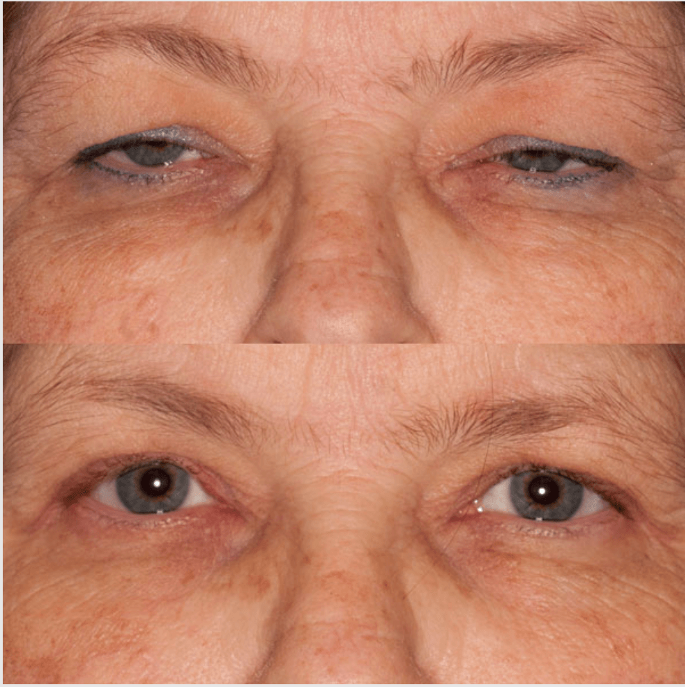 Eyelids before-and-after photograph 46