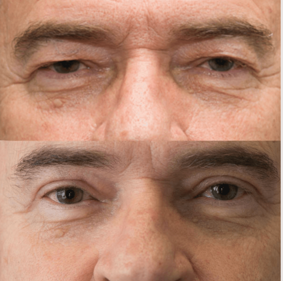 Eyelids before-and-after photograph 47
