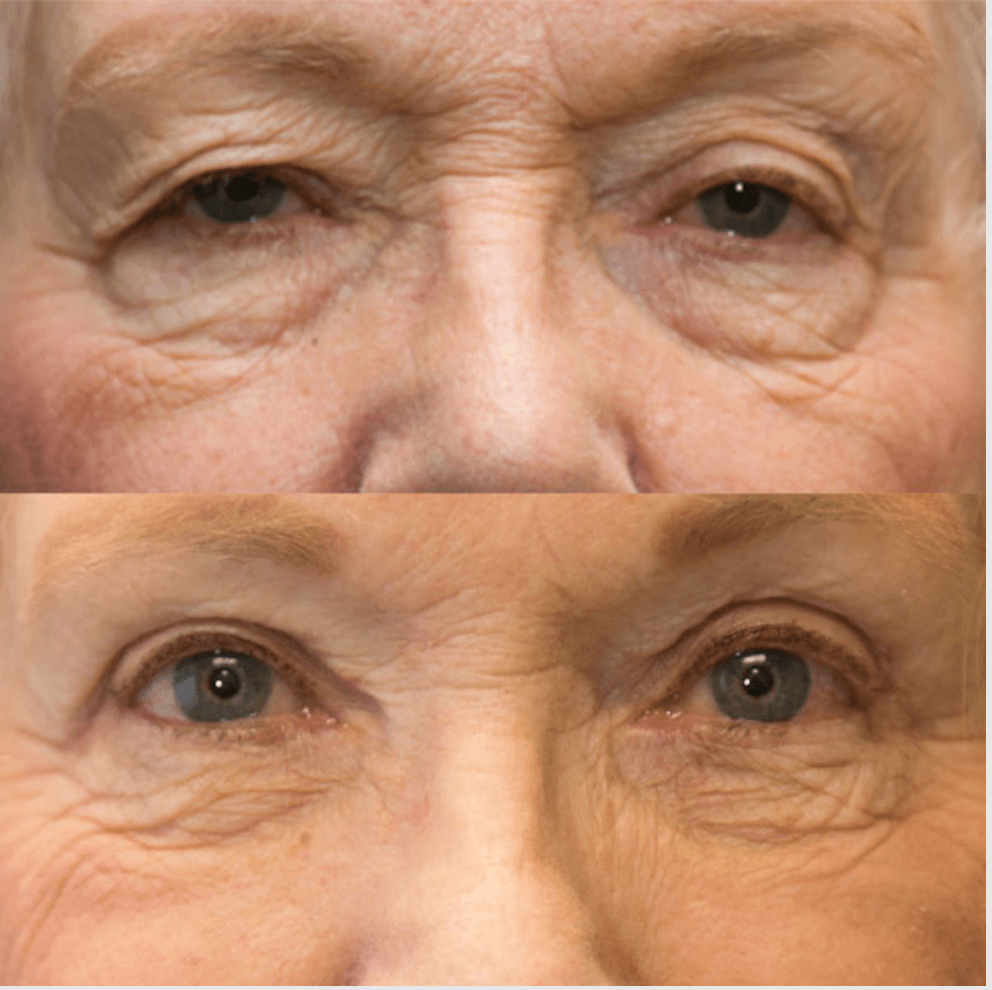 Eyelids before-and-after photograph 48