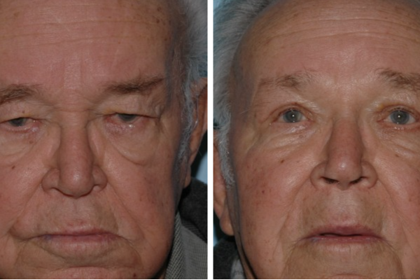 Medical before-and-after photograph 19