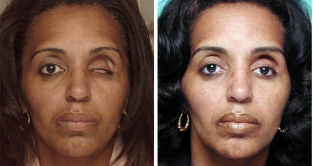 Medical before-and-after photograph 20