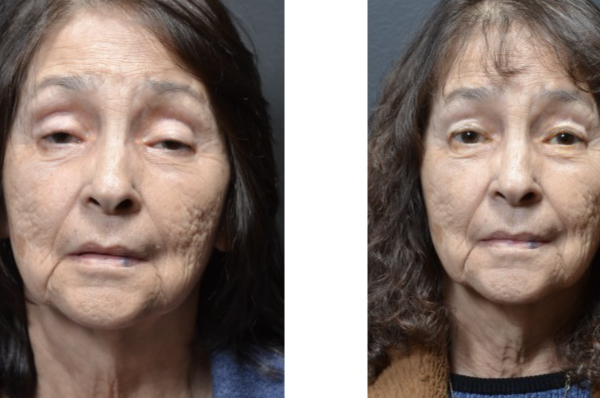 Medical before-and-after photograph 22