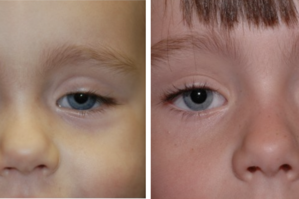 Medical before-and-after photograph 23
