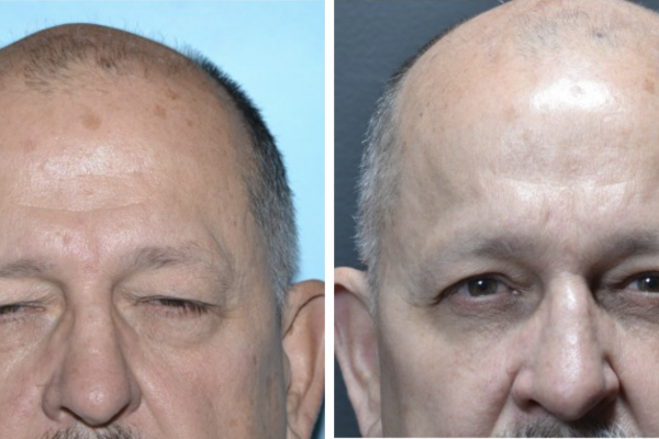 Medical before-and-after photograph 24