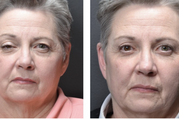 Medical before-and-after photograph 25