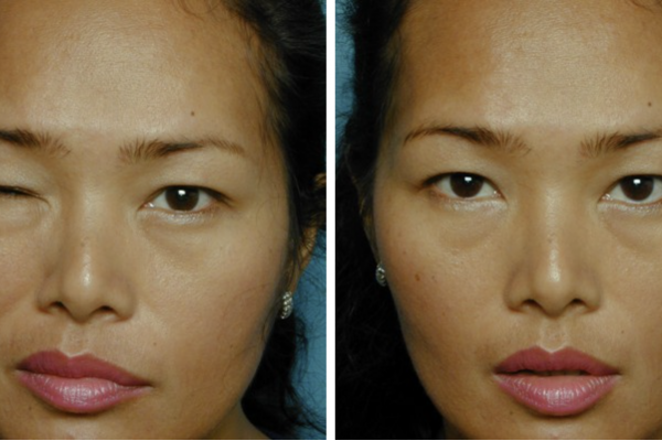 Medical before-and-after photograph 26