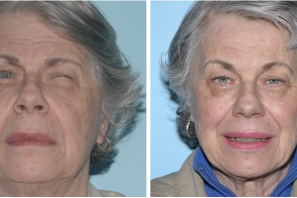 Medical before-and-after photograph 28