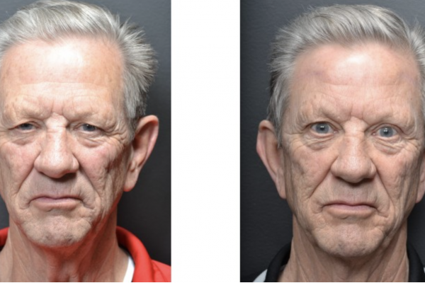 Medical before-and-after photograph 29