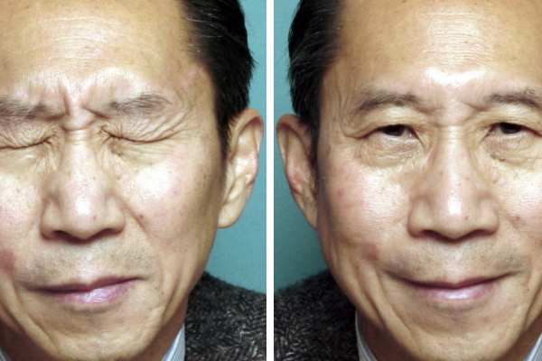 Medical before-and-after photograph 30