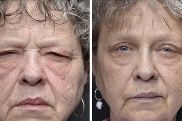 Medical before-and-after photograph 31