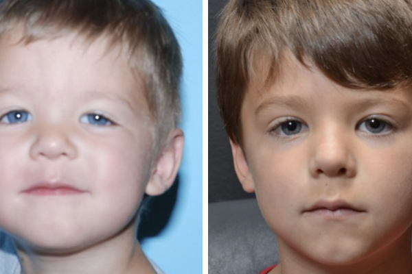 Medical before-and-after photograph 32