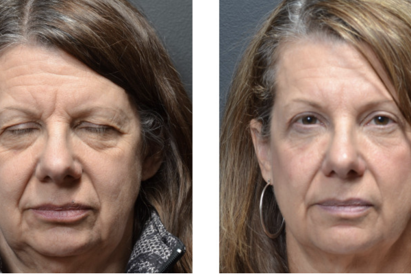 Medical before-and-after photograph 33