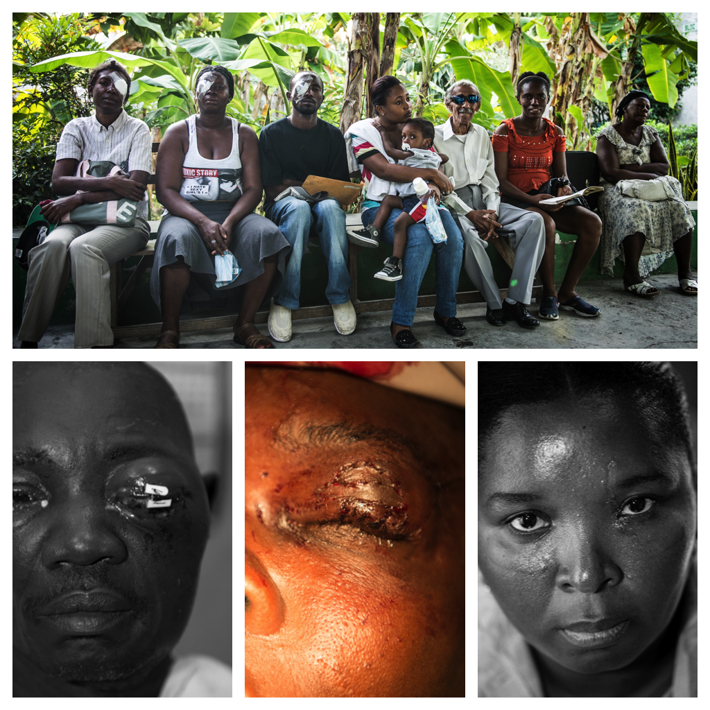 Ophthalmic treatment recovery