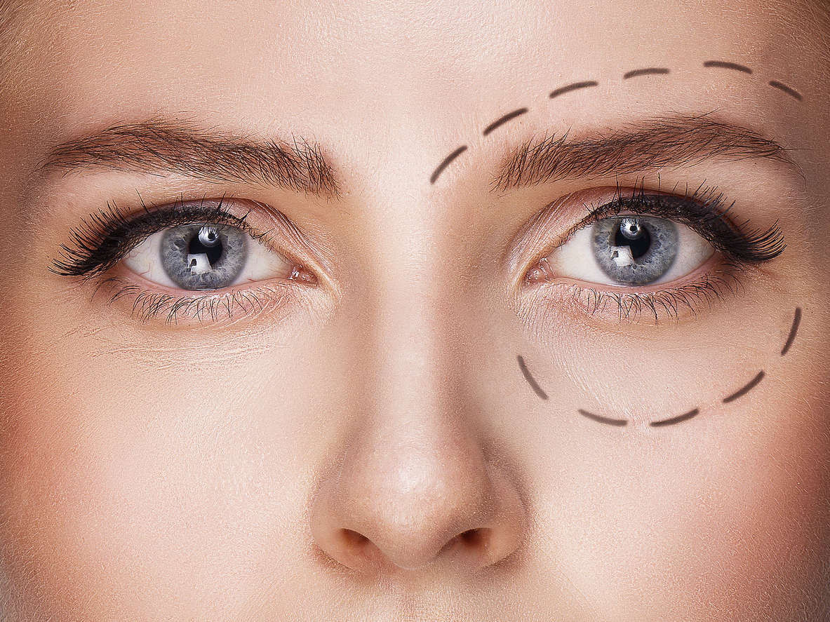 Cosmetic Eye Surgery planning (blepharoplasty)