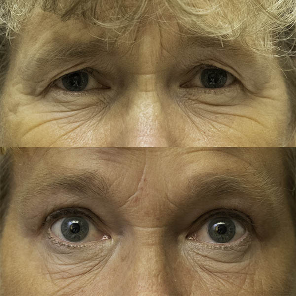 Before-and-After result of Eyelid Surgery