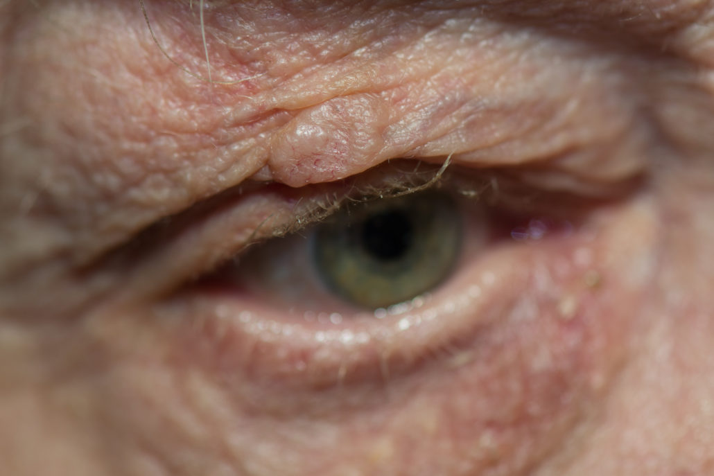 Growth above upper eyelid