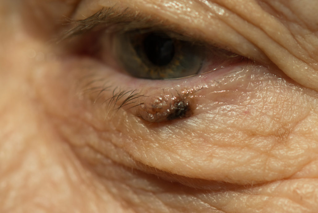 Eye with skin lesion