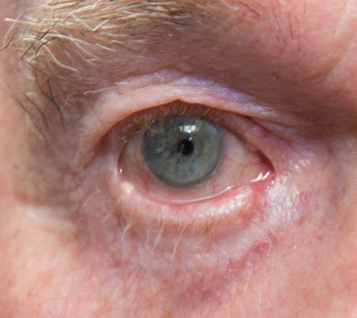 Close-up of eye with mild under-eye puffiness