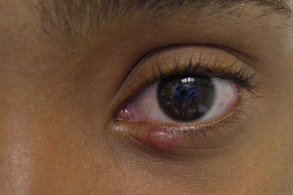 Swollen lower eyelid