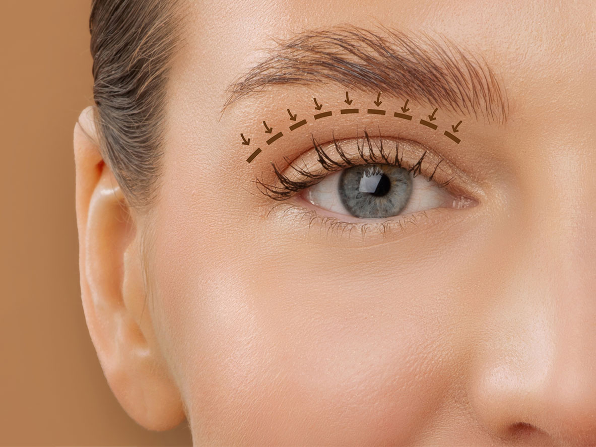 Close-up of an eye with markings illustrating the natural upper eyelid crease and potential blepharoplasty treatment area.