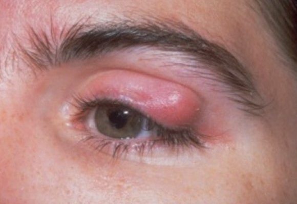 Upper eyelid infection