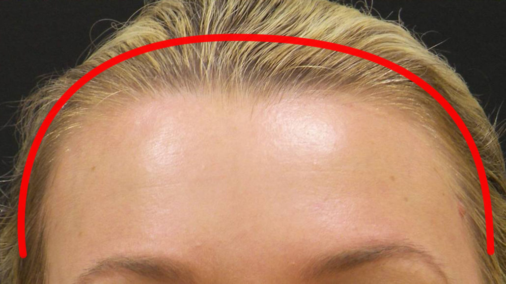 The Coronal Brow Lift