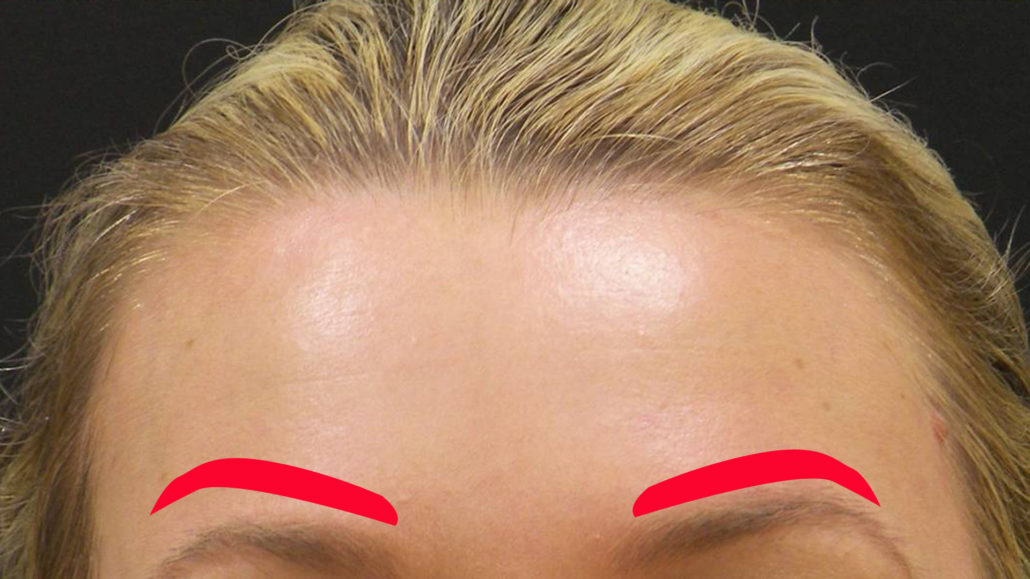 Brow Lift Markings