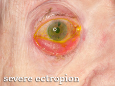 Close-up of eye with severe ectropion and redness