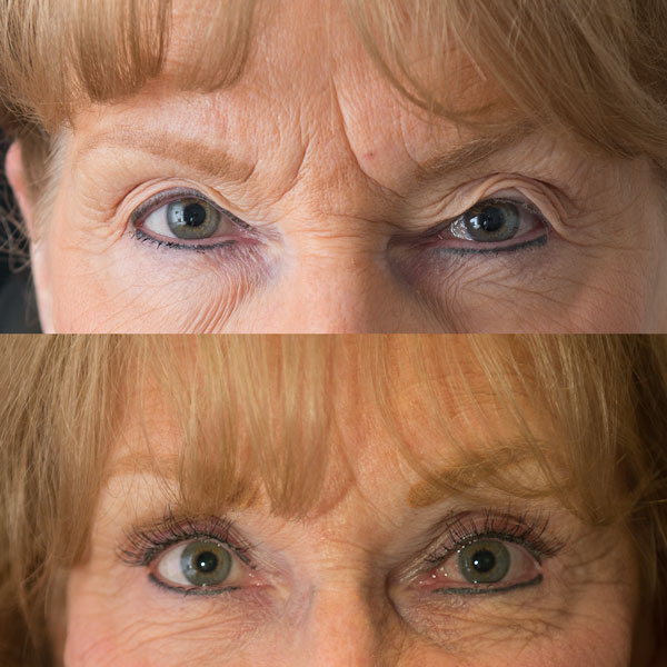 Blepharoplasty before after