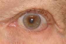Eye showing cloudy lens consistent with cataract