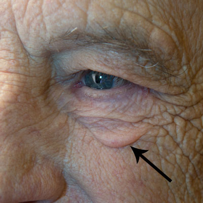 Eye with puffiness under lower lid highlighted
