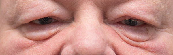 Close-up of elderly man's eyes with puffiness