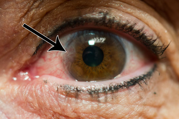 Arrow pointing to eye lesion