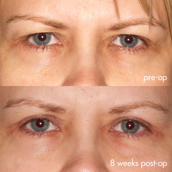 Upper eyelid lift after surgery