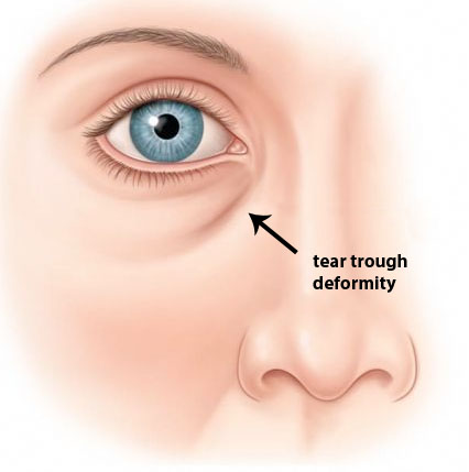 tear trough deformity